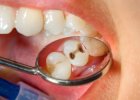 Если начал болеть зуб — необходимо сразу же обращаться к стоматологу