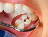 Если начал болеть зуб — необходимо сразу же обращаться к стоматологу